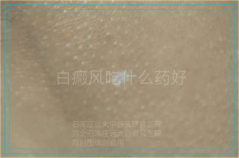 白癜风吃什么药好