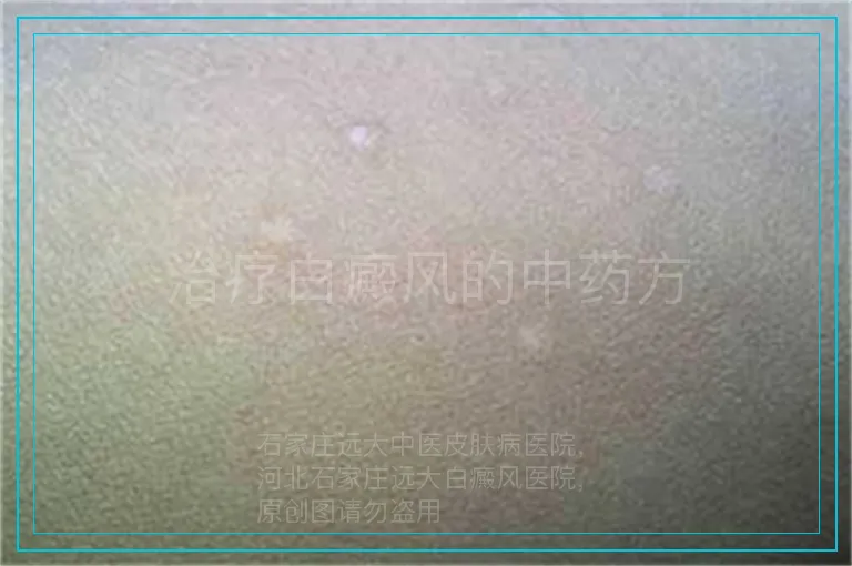 治疗白癜风的中药方