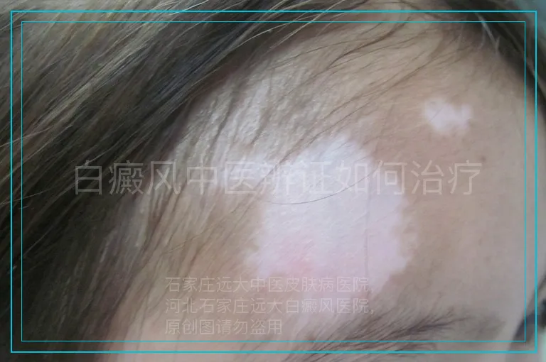 白癜风中医辨证如何治疗