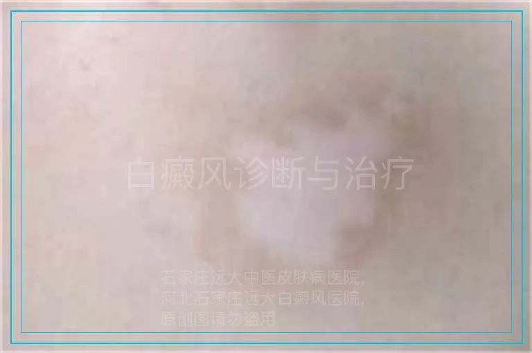 白癜风诊断与治疗