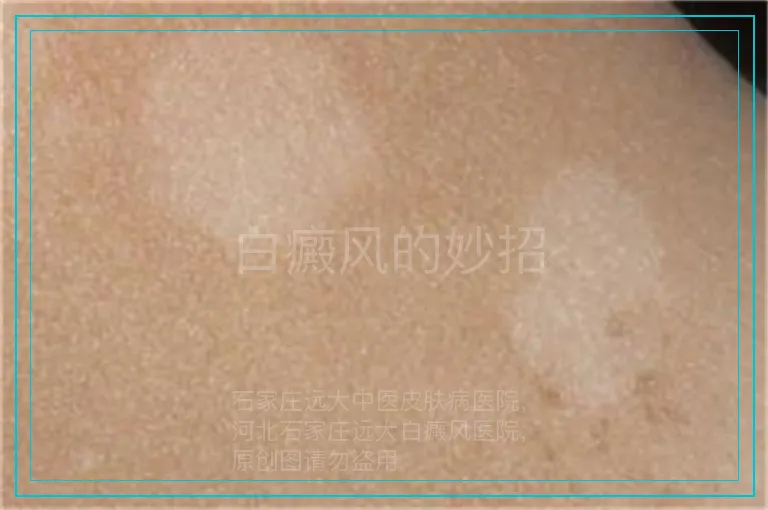 白癜风的妙招