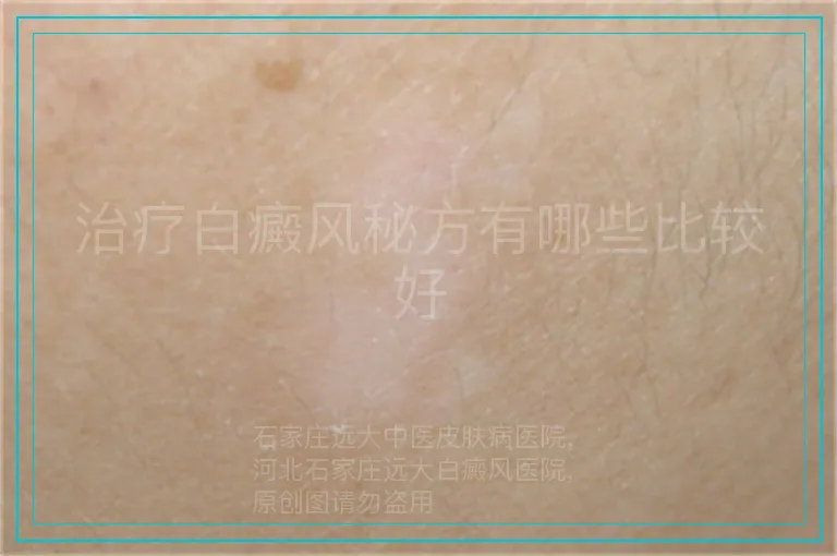 治疗白癜风秘方有哪些比较好