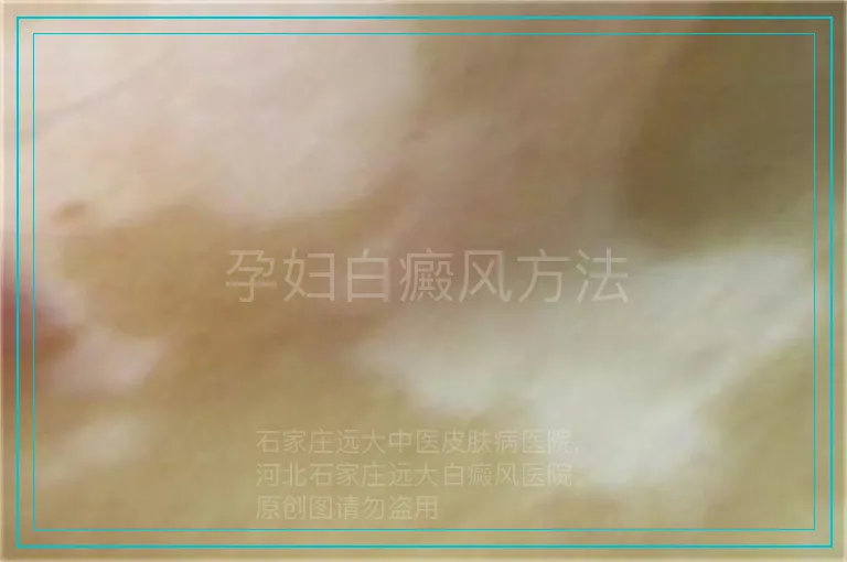 孕妇白癜风方法