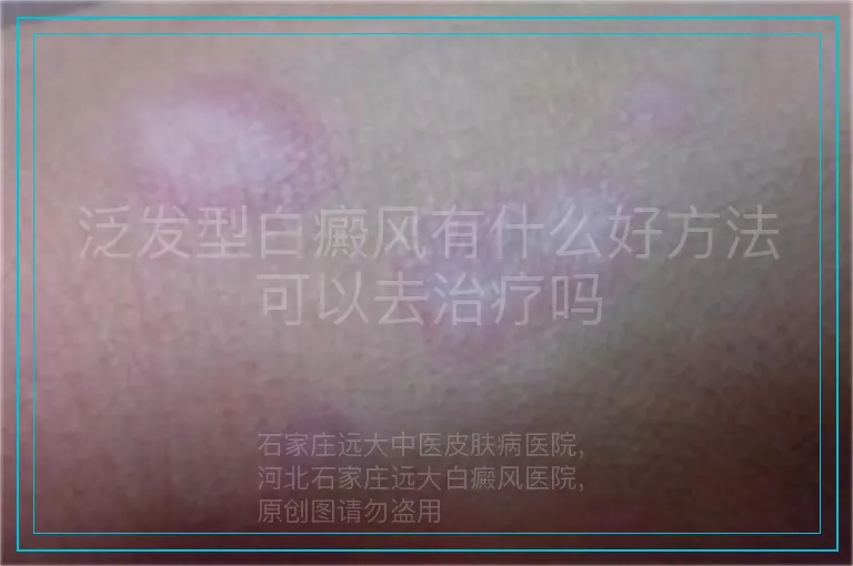 泛发型白癜风有什么好方法可以去治疗吗