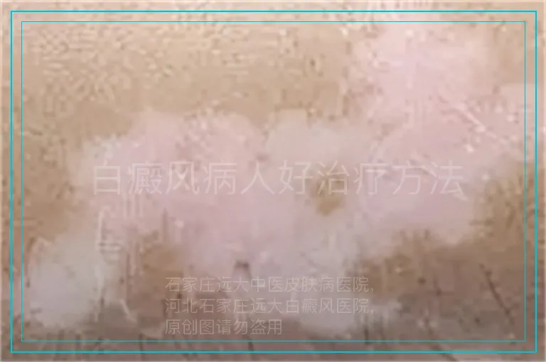 白癜风病人好治疗方法