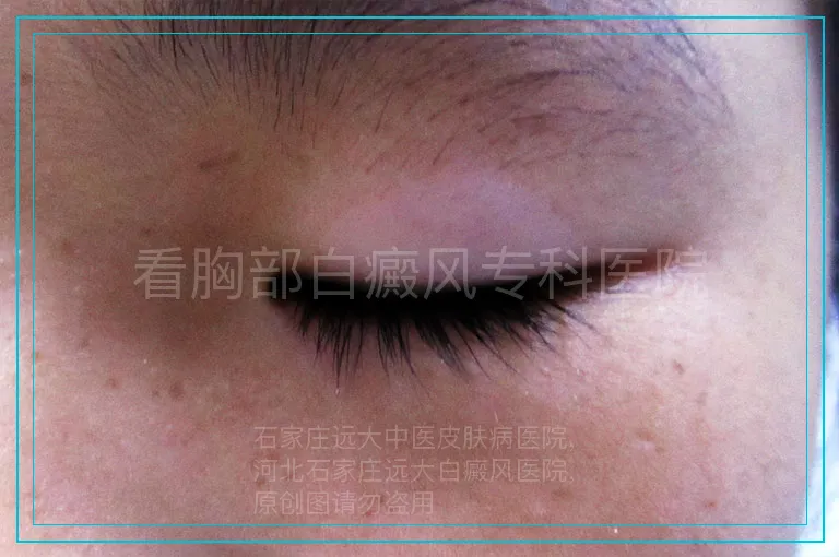 看胸部白癜风专科医院