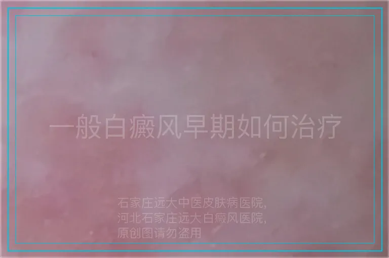 一般白癜风早期如何治疗