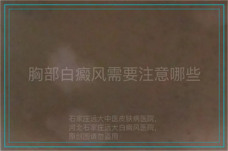 胸部白癜风需要注意哪些