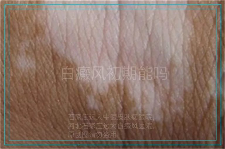白癜风初期能吗