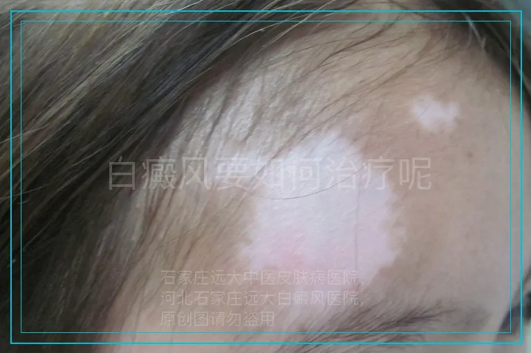 白癜风要如何治疗呢