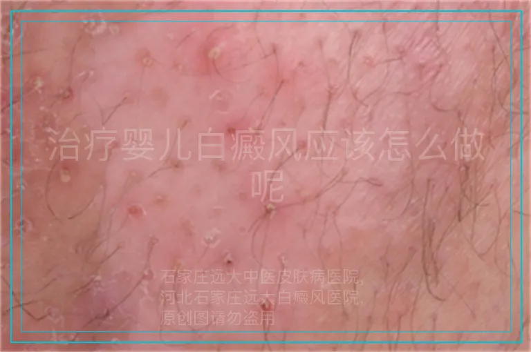 治疗婴儿白癜风应该怎么做呢