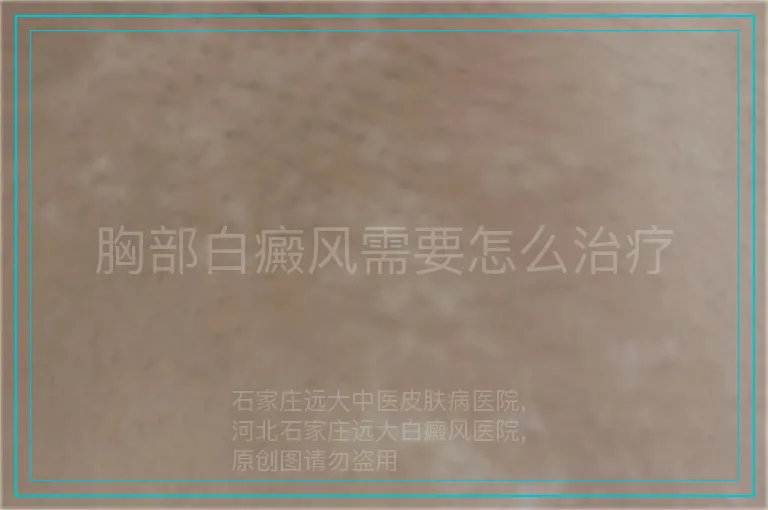 胸部白癜风需要怎么治疗
