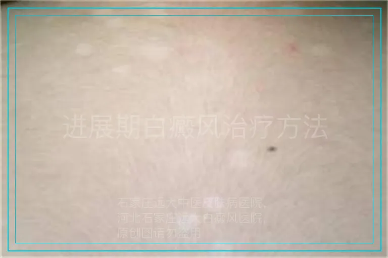 进展期白癜风治疗方法