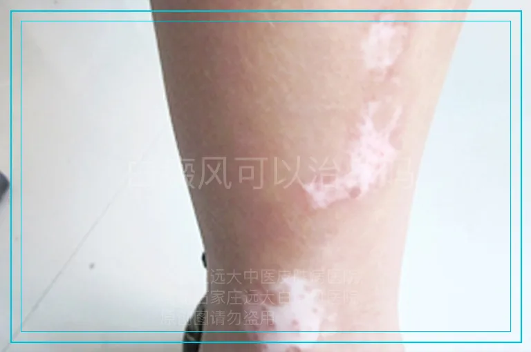 白癜风可以治疗吗
