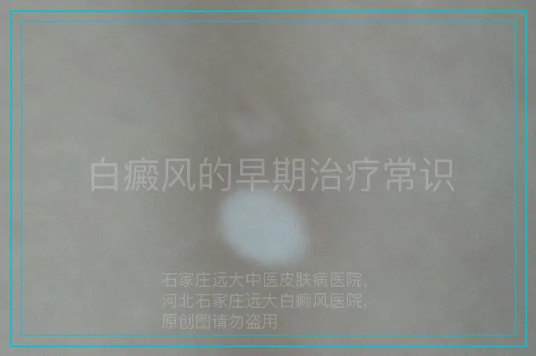 白癜风的早期治疗常识