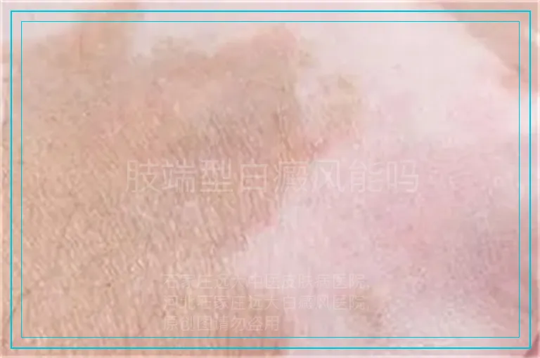 肢端型白癜风能吗