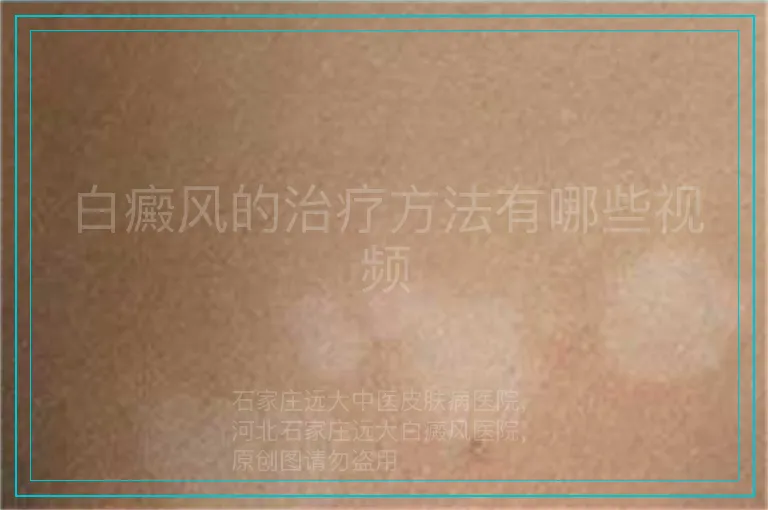 白癜风的治疗方法有哪些视频