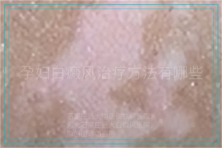 孕妇白癜风治疗方法有哪些