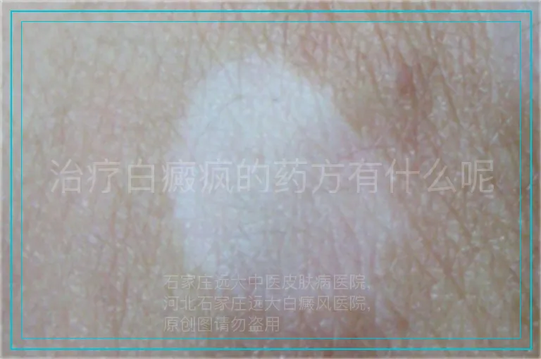 治疗白癜疯的药方有什么呢