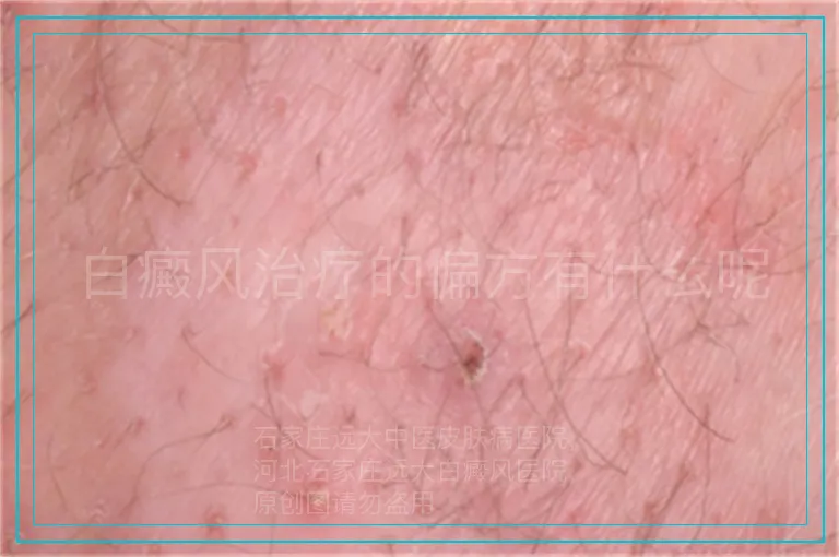 白癜风治疗的偏方有什么呢
