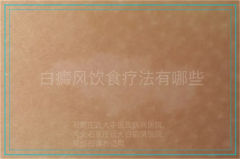 白癜风饮食疗法有哪些
