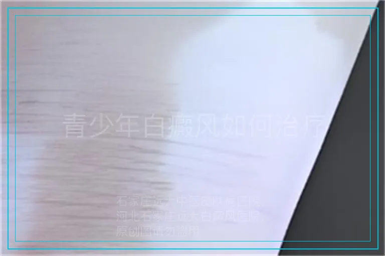 青少年白癜风如何治疗