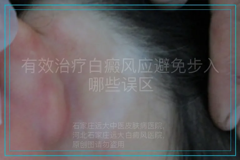 有效治疗白癜风应避免步入哪些误区