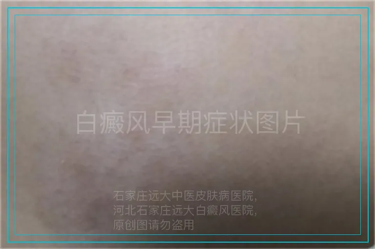 白癜风早期症状图片