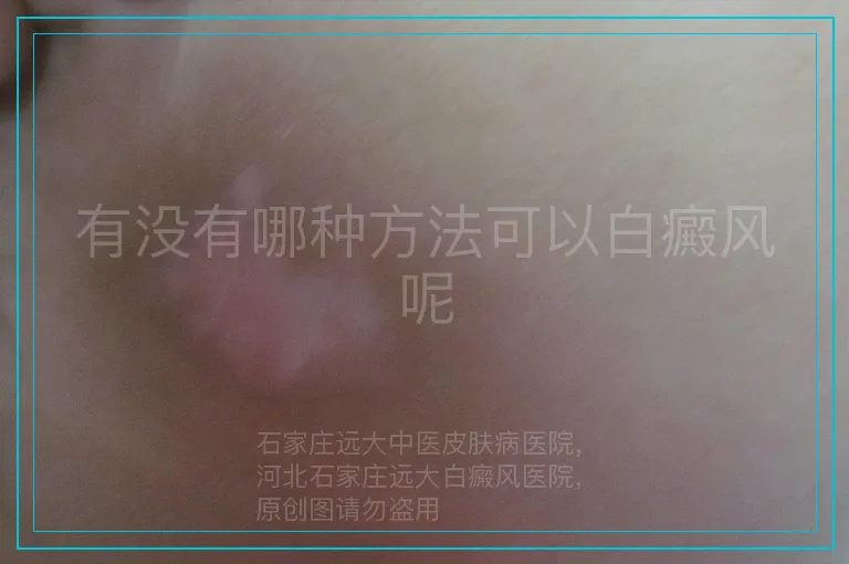 有没有哪种方法可以白癜风呢
