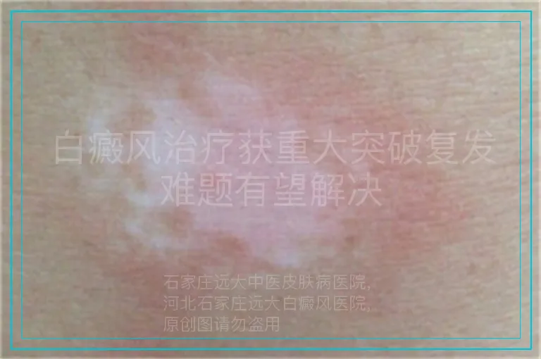 白癜风治疗获重大突破复发难题有望解决