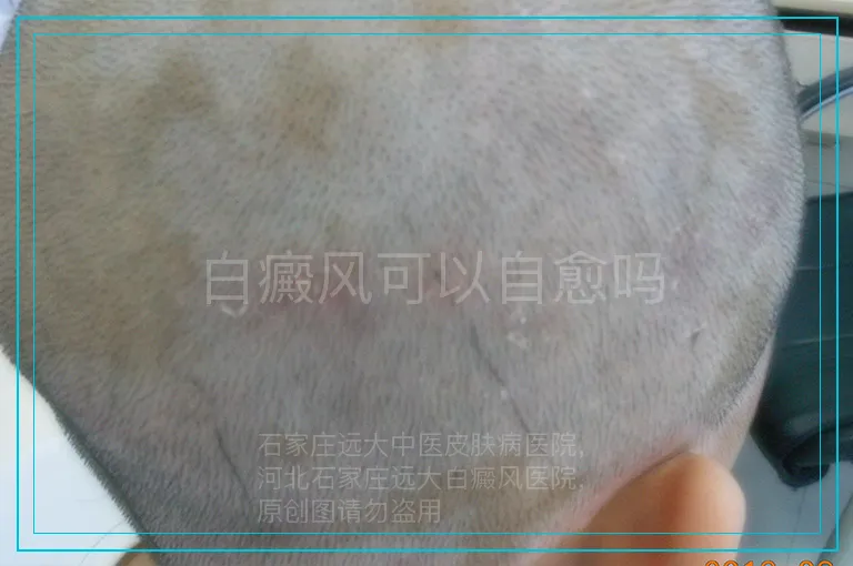 白癜风可以自愈吗