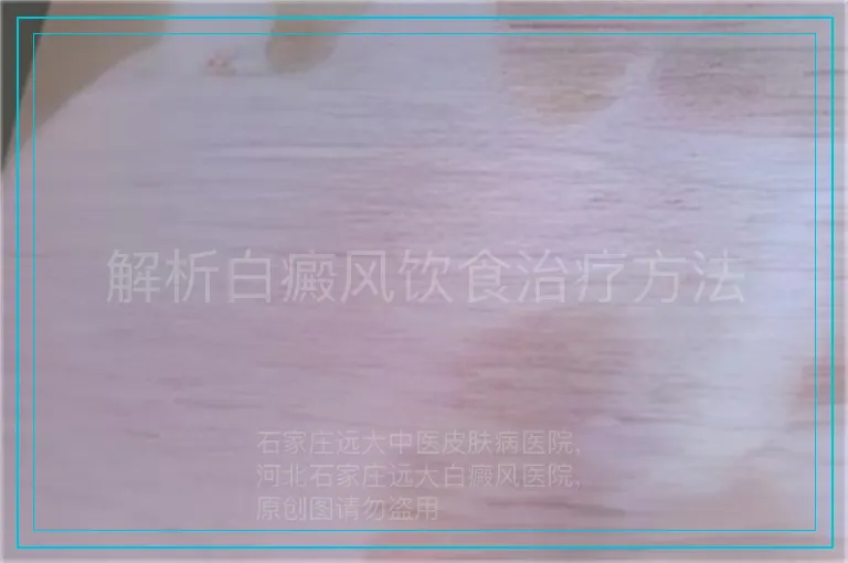 解析白癜风饮食治疗方法