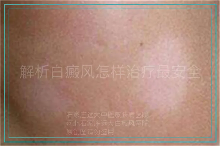 解析白癜风怎样治疗最安全