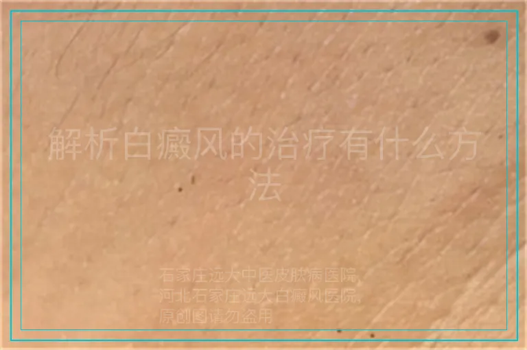 解析白癜风的治疗有什么方法
