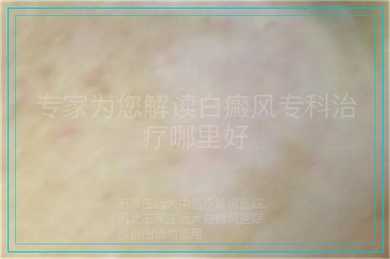 专家为您解读白癜风专科治疗哪里好