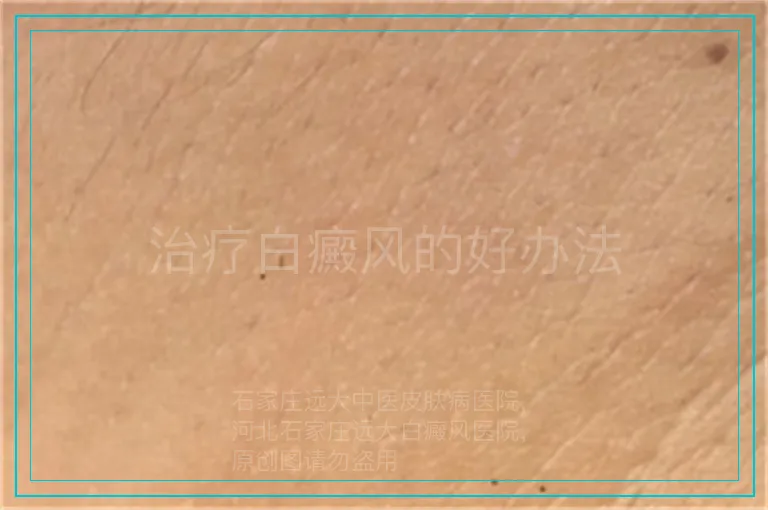治疗白癜风的好办法