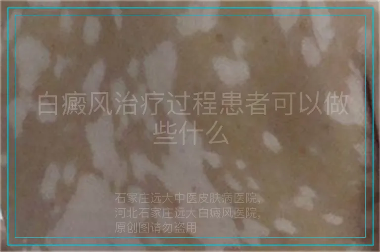 白癜风治疗过程患者可以做些什么