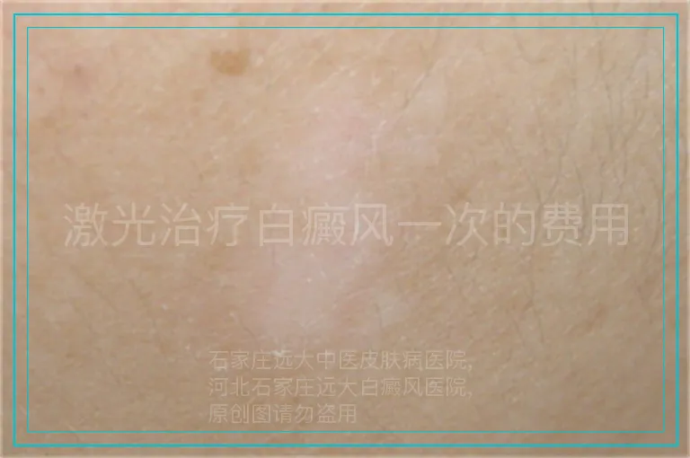 激光治疗白癜风一次的费用