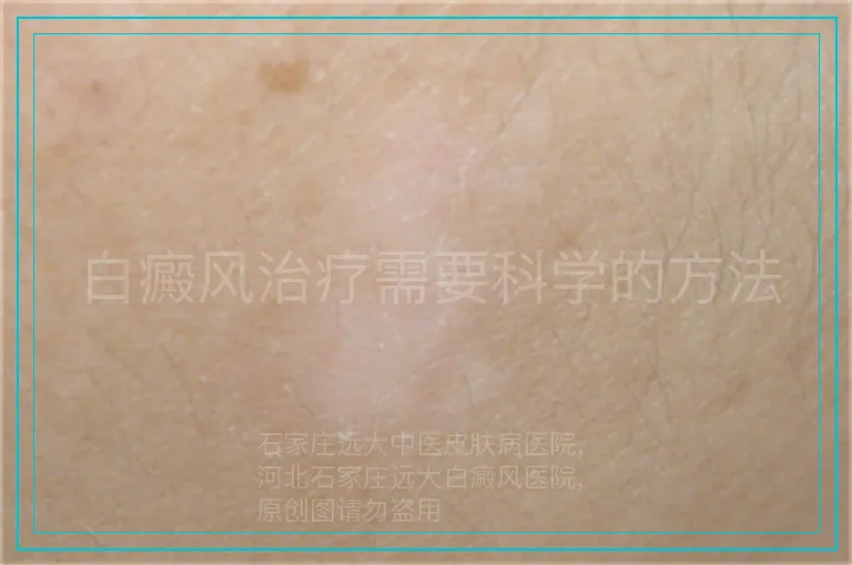 白癜风治疗需要科学的方法