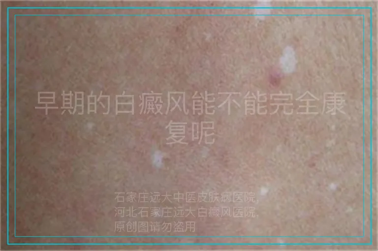 早期的白癜风能不能完全康复呢
