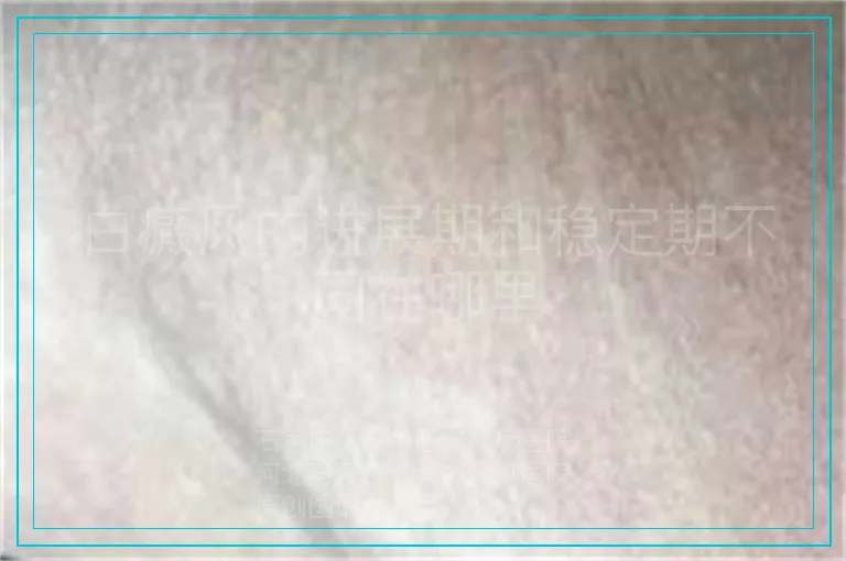 白癜风的进展期和稳定期不同在哪里