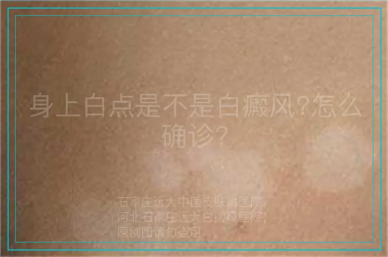 身上白点是不是白癜风?怎么确诊?