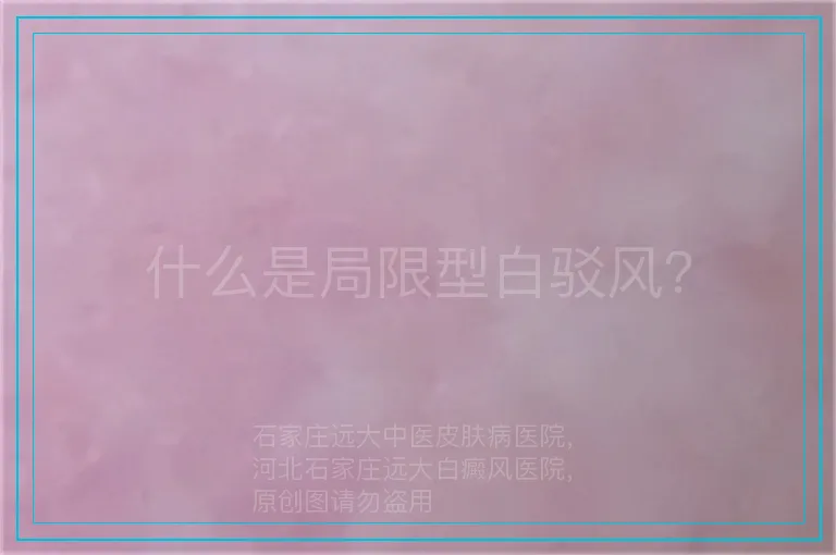 什么是局限型白驳风？