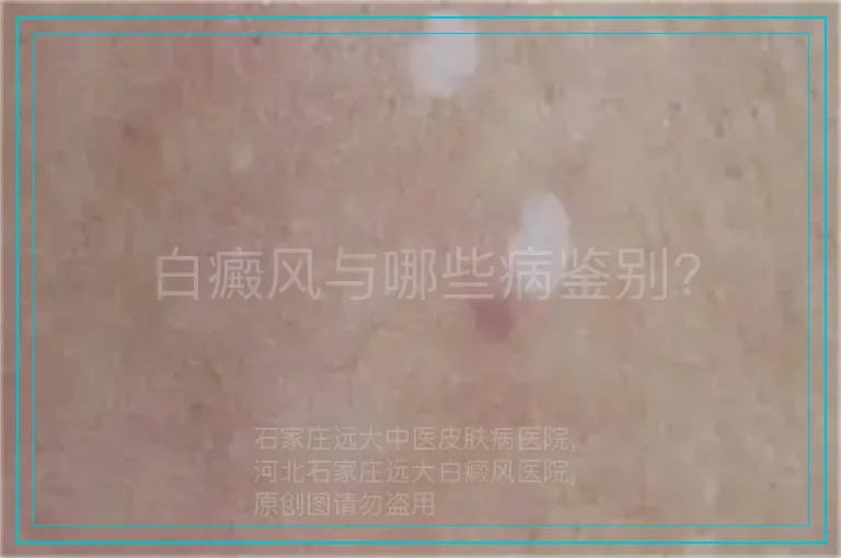白癜风与哪些病鉴别?