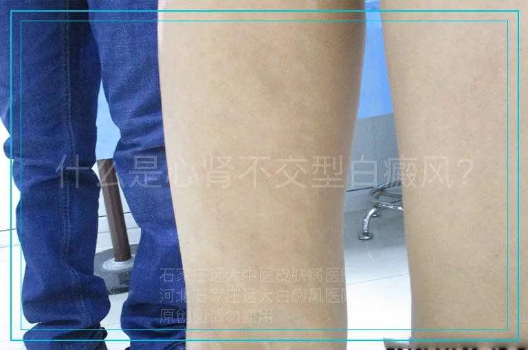 什么是心肾不交型白癜风?