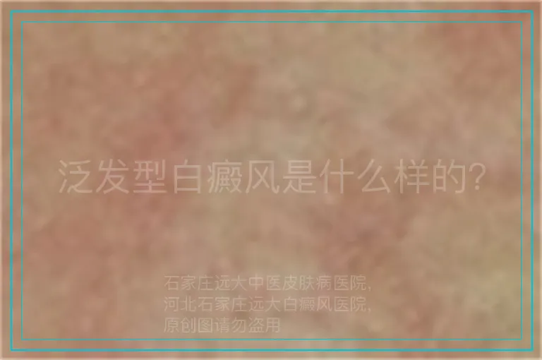 泛发型白癜风是什么样的？