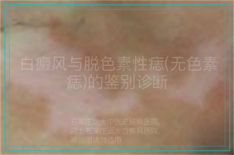 白癜风与脱色素性痣(无色素痣)的鉴别诊断