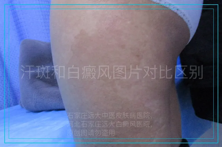 汗斑和白癜风图片对比区别
