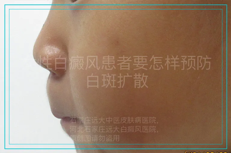 女性白癜风患者要怎样预防白斑扩散