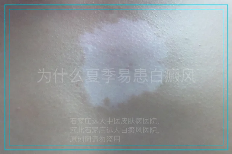 为什么夏季易患白癜风